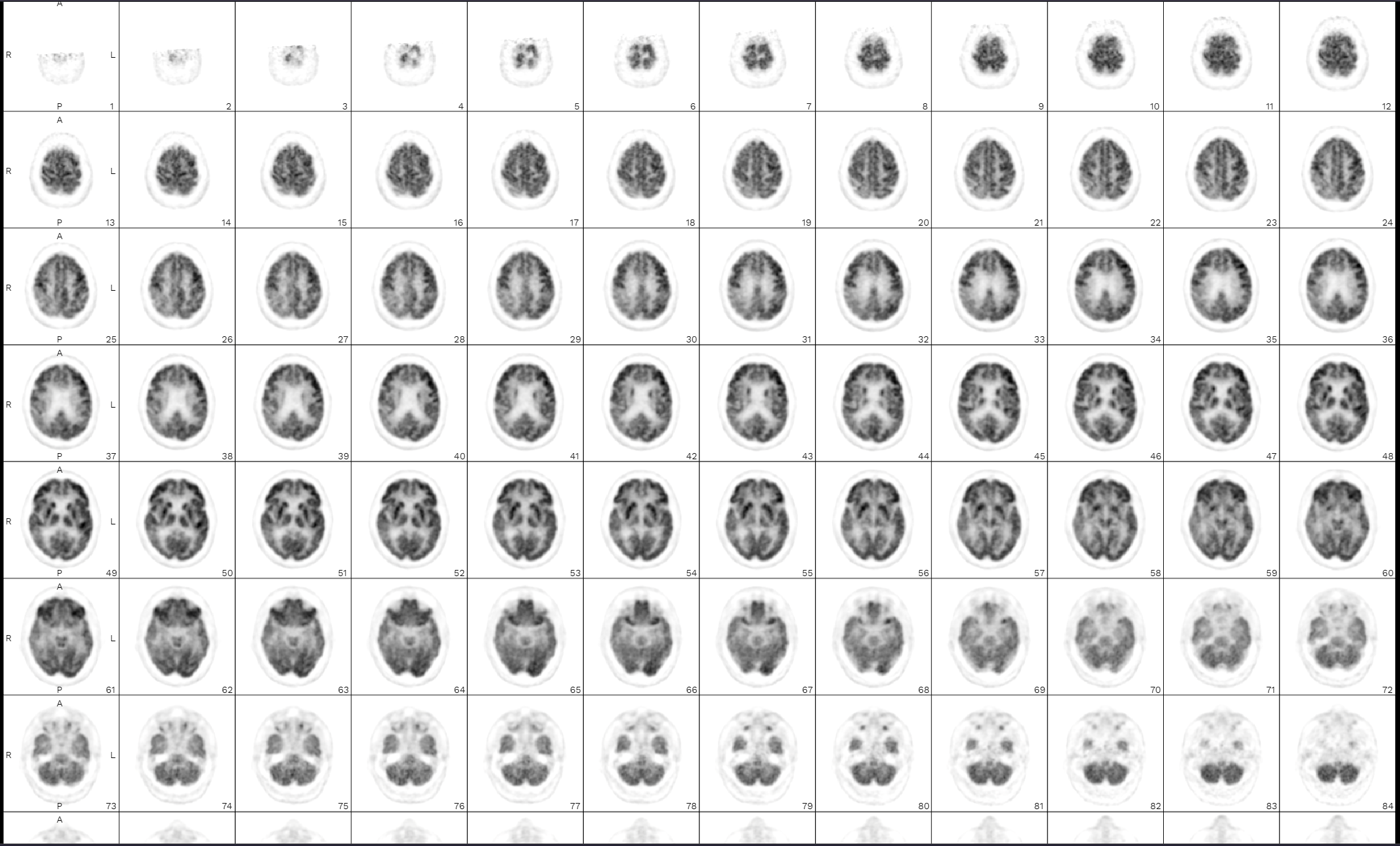 Montage of FDG-PET axial brain slices showing regional glucose metabolism