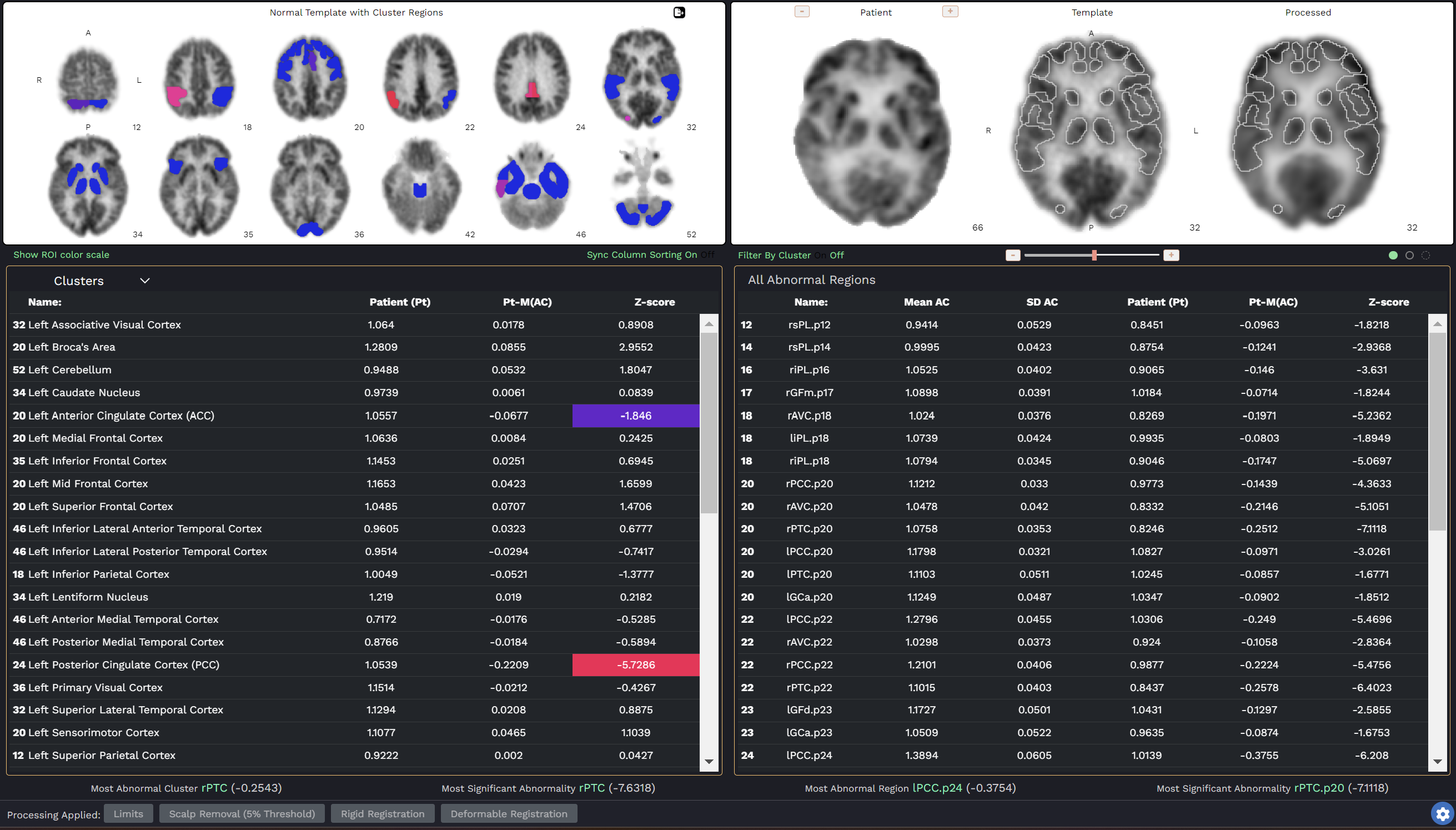 NeuroQ analysis interface comparing a patient brain PET scan against a normal template with cluster regions and regional Z-score tables